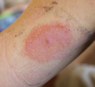 Réaction allergique au FreeStyle Libre d'Abbott - Dermite allergique de contact